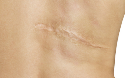 Il trattamento delle cicatrici anomale