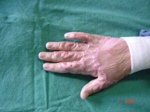 Cicatrice cheloide dorso mano